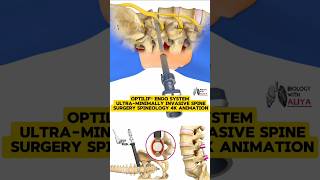 OptiLIF® Endo System  UltraMinimally Invasive Spine Surgery  Spineology  4K Animation 3d short [upl. by Ahsemot213]