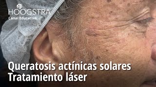 Queratosis actínicas solares  Tratamiento láser  23275 [upl. by Saundra]