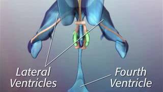 Anatomy of Hypothalamic Hamartoma [upl. by Ecyrb915]