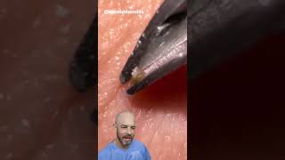 This ingrown hair removal is short and sweet credit blemishbandits on TT doctor satisfying [upl. by Shoshanna]