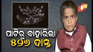 Doctors Extract 526 Teeth From 7YearOld’s Mouth [upl. by Spearman]