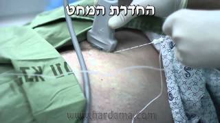 חסם עצבי פמורלי Femoral block [upl. by Almeeta]