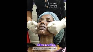 MicroneedlingtreatmentShubiksha hair and skin care clinicbalaji Nagarkatturtrichy199150923153 [upl. by Wolff340]