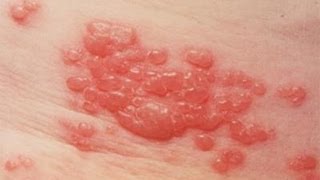 DermTV  Shingles  Herpes Zoster DermTV Epi 425 [upl. by Kelwin]