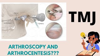 Temporomandibular joint TMJ Arthroscopy and ArthrocentesisBasics Short note [upl. by Lokcin]