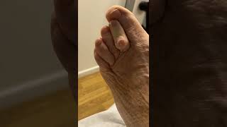 Watch as our podiatrist works miracles on a stubborn ulcerated corn FootHealth PodiatryMagic [upl. by Airliah769]