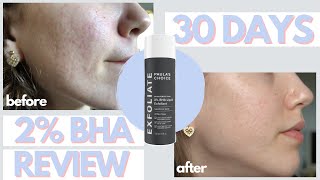 I Used Paulas Choice 2 BHA Liquid Exfoliant On My Acne Scars for 30 Days  Honest Review [upl. by Kamat]