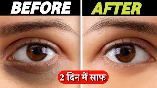 Say Goodbye to Dark Circles in 2 Weeks  Ranu Patel [upl. by Anel]