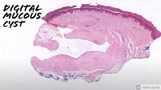 Digital Mucous Cyst vs Ganglion Cyst 5Minute Pathology Pearls [upl. by Lovett]