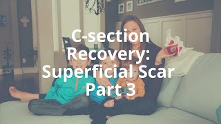 How I Healed After My Csections Scar Work [upl. by Mireielle585]