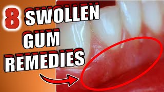 8 Home Remedies To Get Rid of Swollen Gums [upl. by Schell]