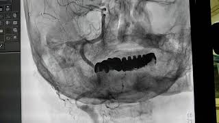 Carotid angiogram [upl. by Analed]