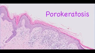 Porokeratosis [upl. by Himelman966]