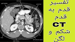 آموزش قدم به قدم تفسیر Abdominopelvic CT Scan جلسه سوم [upl. by Witherspoon]