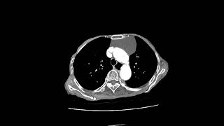 thymic cyst [upl. by Eirehc269]