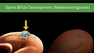 Fetal Spina Bifida Comprehensive Guide on Diagnosis Treatment amp Surgery [upl. by Cohberg]