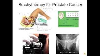 Competence in Cancer Care Prostate Cancer Overview [upl. by Meier809]