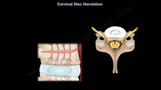 Cervical Disc Herniation What Is The Intervertebral Disc what is a disc herniation [upl. by Rhoads]