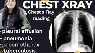 Chest XRay  XRay reading CP Angle  chest thoracic ratio broncho vascular measurement Hindi [upl. by Llamaj]