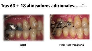 Claves de Éxito en Exodoncia Asimétrica y distalamiento secuencial con Invisalign [upl. by Wendy]