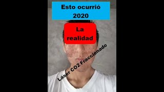 Láser CO2 fraccionado 2020 actual Resultados antes y despues experiencia fotos cicatrices Perú [upl. by Mcclelland246]