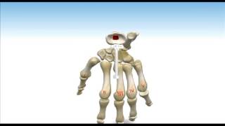 ReMotion™ Total Wrist Arthroplasty  Animated Surgical Technique [upl. by Madancy504]