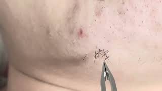 【INGROWN HAIR REMOVAL】ひたすら髭抜き PART331 [upl. by Inele]