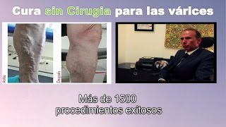 Cura para venas varices SIN CIRUGIA en Bogota Colombia  Tratamiento Ulceras varicosas Linfedema [upl. by Ehc473]