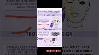 Hypocalcemia  Trousseaus sign amp Chvostek sign importantquestions nursingofficer nursing [upl. by Lirba]