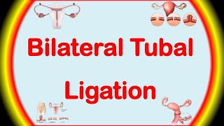 Bilateral Tubal Ligation  Permanent Birth Control Method  Family Planning [upl. by Diane-Marie271]