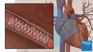 How coronary angioplasty is carried out  Bupa Health [upl. by Anez]