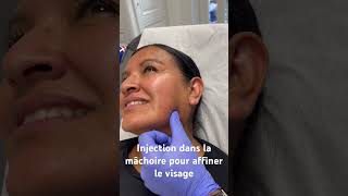 Injection de Botox dans la mâchoire pour affiner le visage DrHerveRaspaldo [upl. by Talbott]