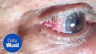 GRAPHIC Moment 15cm long worm is removed from mans eye [upl. by Eelyahs175]