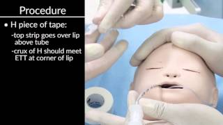 quotSecuring Oral and Nasal Endotracheal Tubesquot by Craig Smallwood RRT for OPENPediatrics [upl. by Wally]