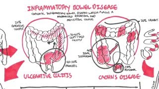 Ulcerative Colitis Crohns Disease amp Diverticulitis  MedicalSurgical GI  LevelUpRN [upl. by Fevre]