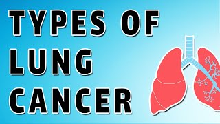 Neuroendocrine Lung Tumors [upl. by Otrebide]