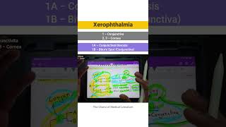 Xerophthalmia  Vitamin A deficiency tcml shorts shortsyoutube [upl. by Dnar797]