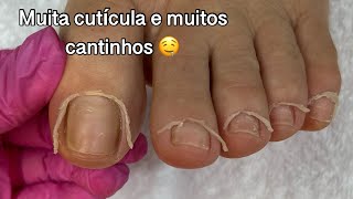 PEDICURE  TRANSFORMAÇÃO [upl. by Aisercal]