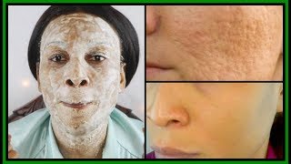 THE SECRET TO SHRINK LARGE PORES IN 3 DAYS 100 RESULTS  MAGIC REMEDY Khichi Beauty [upl. by Zinnes]