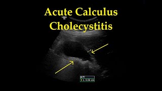 Acute Cholecystitis with Cholelithiasis  Ultrasound  Case 18 [upl. by Elison]