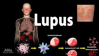 Lupus Symptoms Risk factors Pathophysiology Diagnosis and Treatments [upl. by Notsniw]