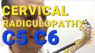 What Is C5 C6 Radiculopathy What Causes Cervical Radiculopathy Dr Walter Salubro [upl. by Thorsten68]