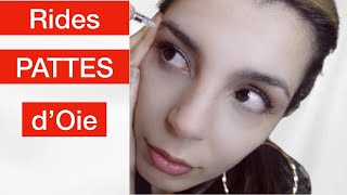 Je Traite les Pattes doie Botox Etape par étapes Rides autour des yeux [upl. by Hedley]