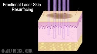 Traditional versus Fractional Laser Skin Resurfacing Procedure Animation [upl. by Flor553]