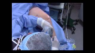 Endovenous Radiofrequency Ablation Training Video [upl. by Justicz]