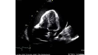 Cardiac Tamponade  Large Pericardial Effusion [upl. by Alikee]