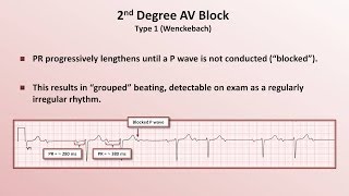 Intro to EKG Interpretation  AV Block [upl. by Welbie]