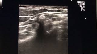 OneMinuteMartinoli video Brachial plexus en Long thoracic nerve [upl. by Landy]