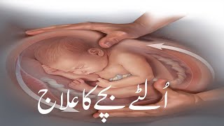 Breech baby Treatment  Pregnancy Mai Ultay Bachy ka Ilaj By Dr Amber Shaheen [upl. by Marrilee]