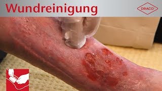 Wundreinigung Debridement bei chronischer Wunde  Verbandswechsel  DRACO [upl. by Harolda]